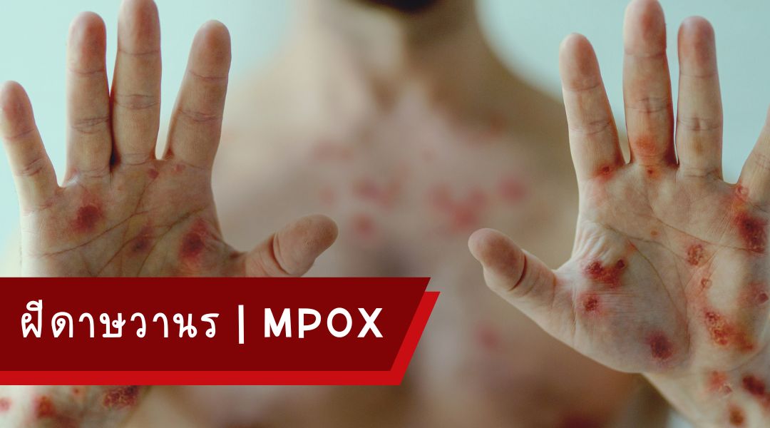 ฝีดาษวานร Mpox